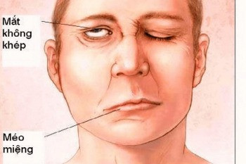 Dấu hiệu liệt dây thần kinh số 7